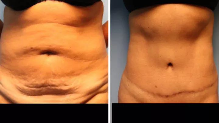 Before and after photos from a woman who received a tummy tuck