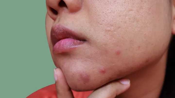Close up of a woman's face with acne