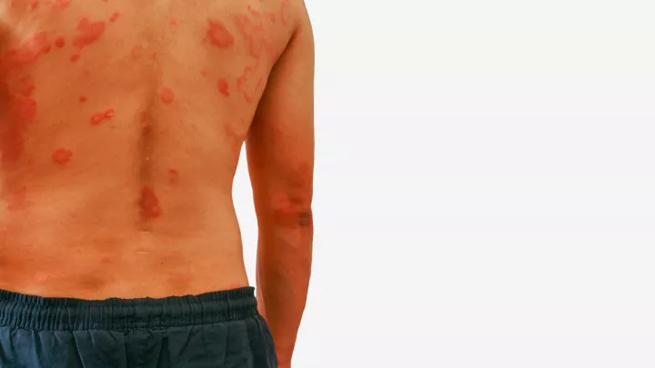 Man's back covered in a rash