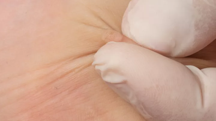 How to identify and treat common warts