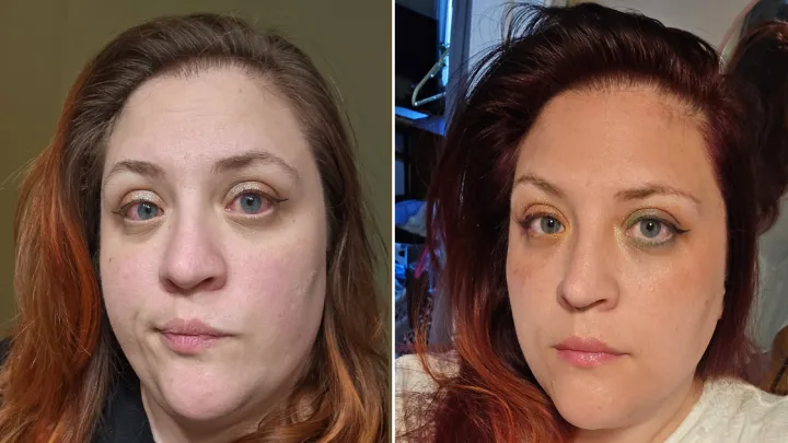 Erin Solheim before and after treatment