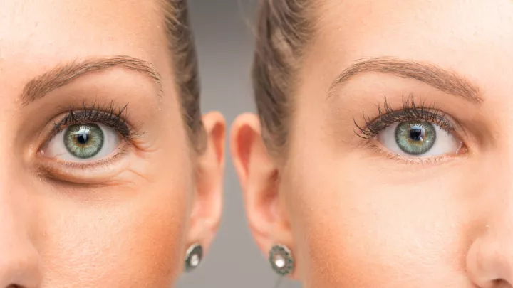 Before and after of eyelid surgery