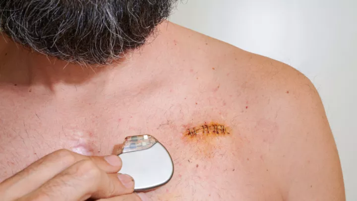 Man holding a pacemaker over a scar on his chest