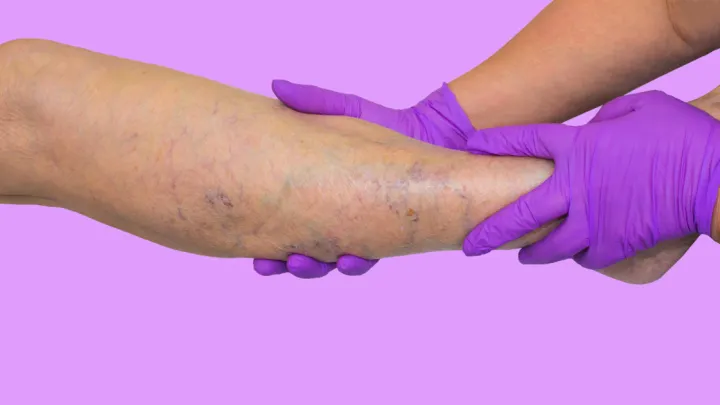 Leg with venous insufficiency