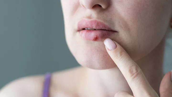 picture of a woman with a cold sore