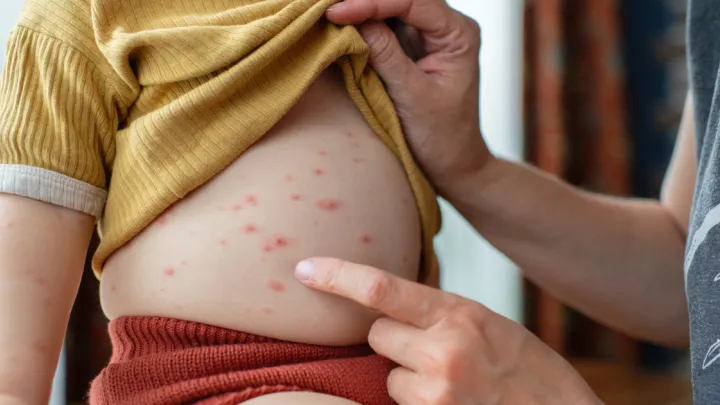 Close up of mother looking at child's stomach with chickenpox