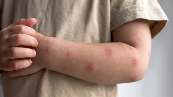Close up of child's arm with rash