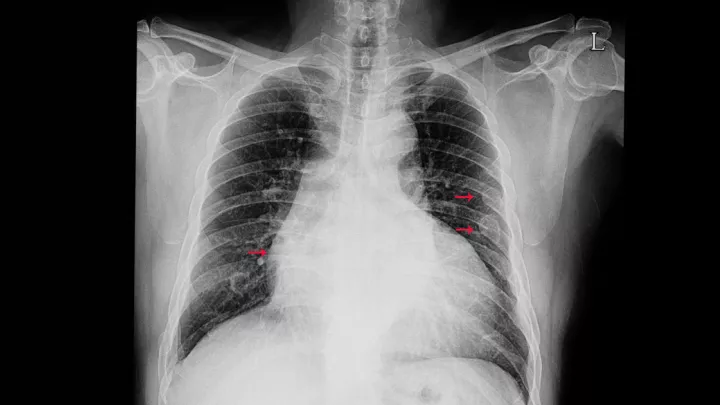 X-ray of broken rib