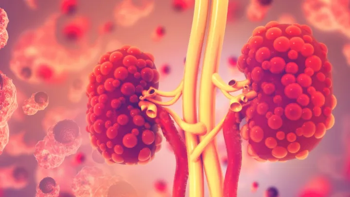 Medical illustration of diseased kidneys