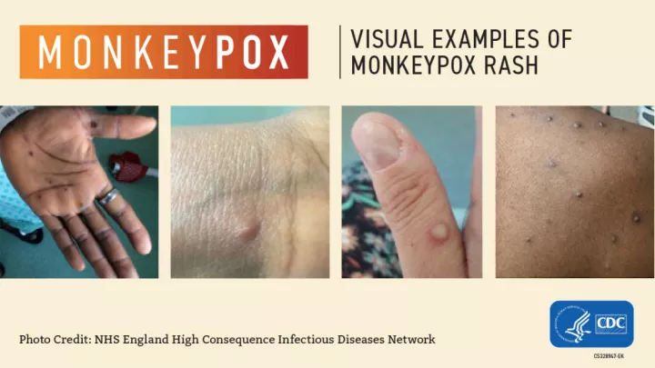Monkeypox visual