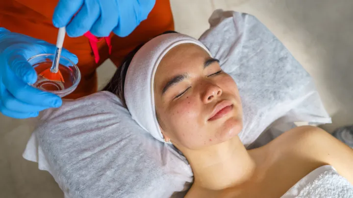 Woman getting chemical peel