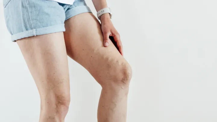 Woman's legs with varicose veins