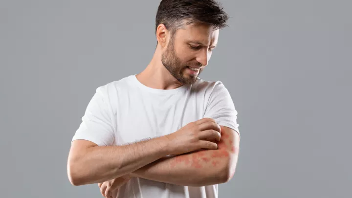 Man scratching rash on arm