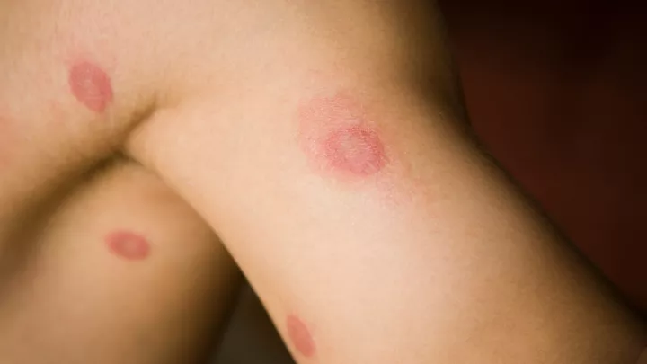 Close up of a person's skin with ringworm
