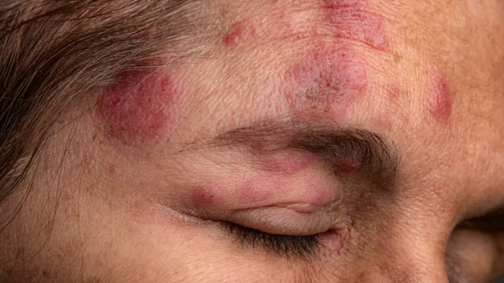 Close up of woman with ocular shingles
