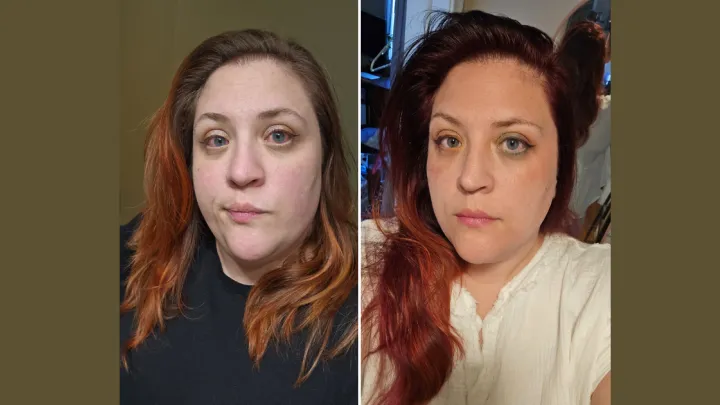 Erin Solheim before and after treatment