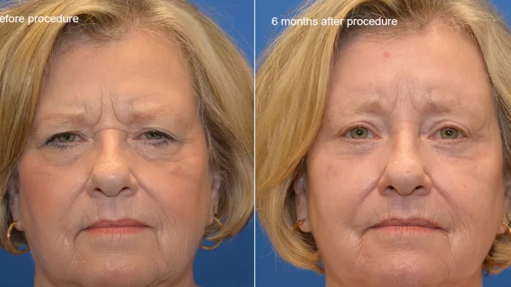Woman before and after facial resurfacing