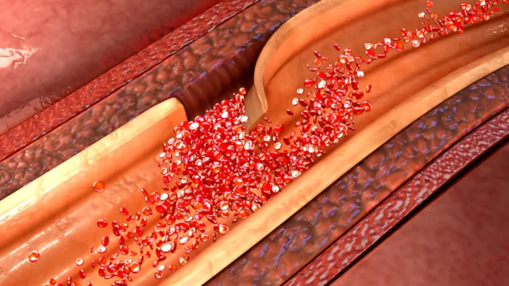 Medical illustration of aortic dissection