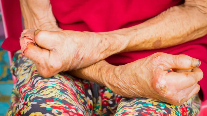 Close up of an old woman's hands affected by leprosy
