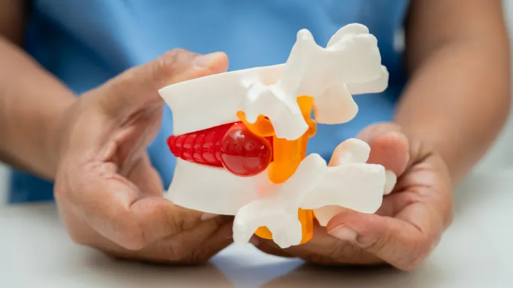 Asian doctor holding spinal nerve and bone model, Lumbar spine displaced herniated disc fragment for treatment medical in the orthopedic department.