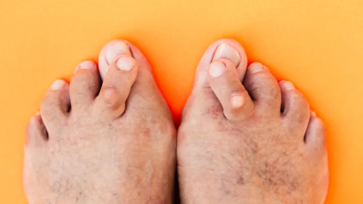 Close up of man's feet with hammertoes